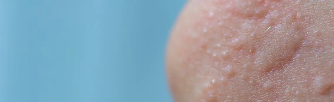 Anaphylaxis Management